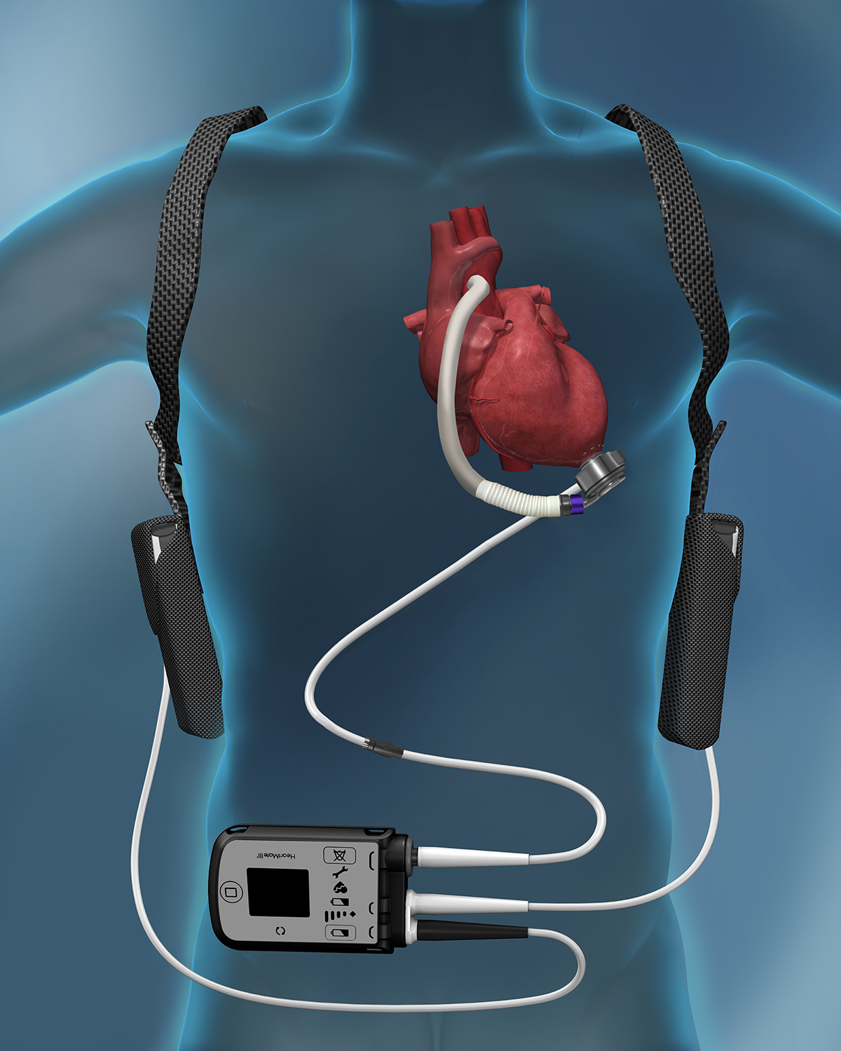 ventricular-assist-device-vad-lvad-new-jersey-valley-health-system